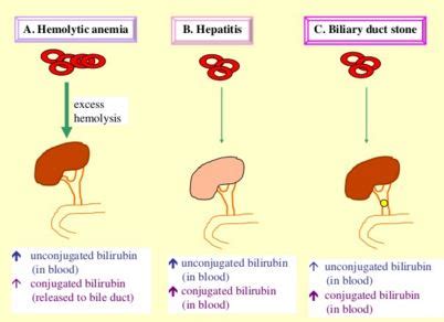 bilirubina 1 in urina|What Bilirubin in Urine Means: Causes, Symptoms